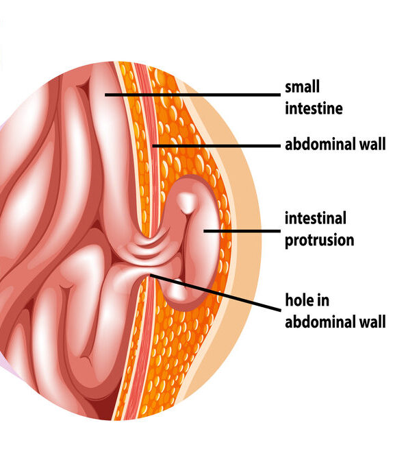 Hernia