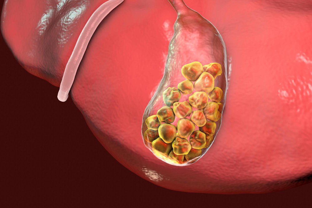 Cholecystitis