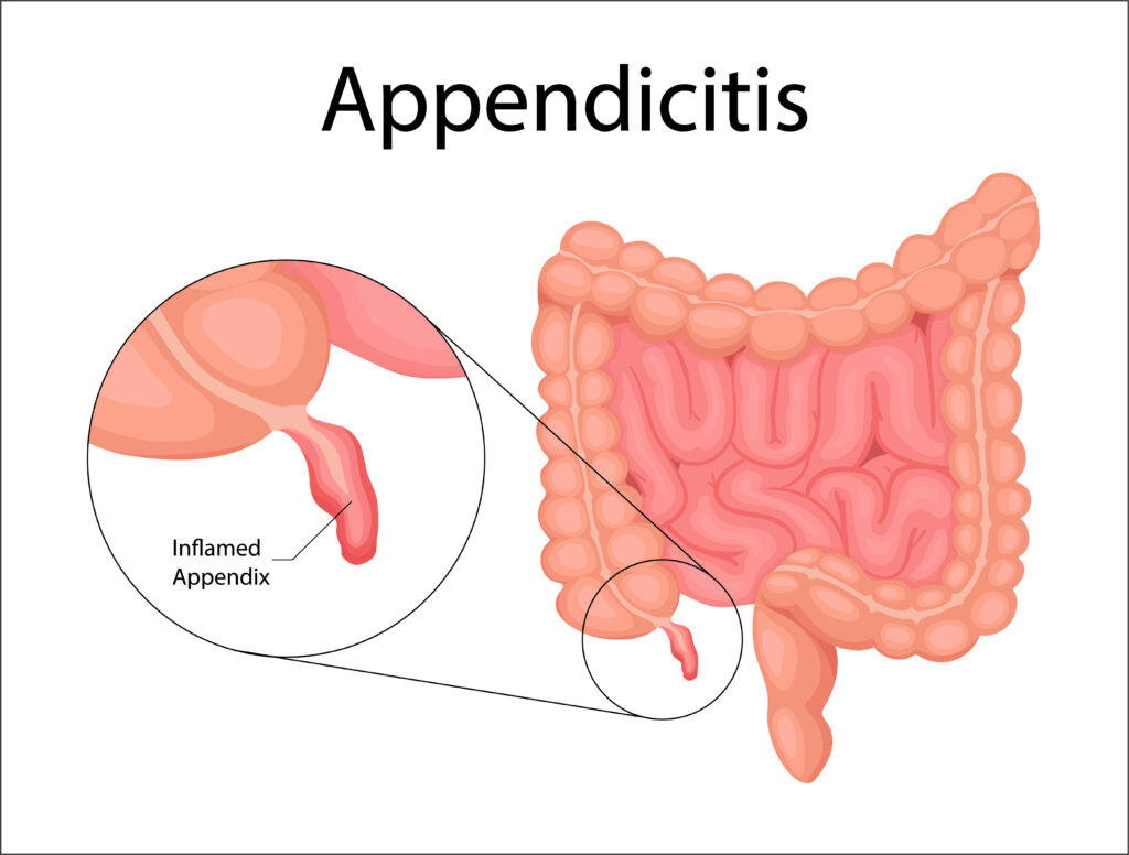 appensicitis